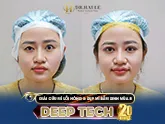 Sửa mí lỗi hỏng
