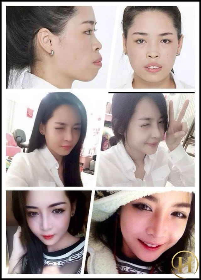 Hot girl thành Nam “gây sốt” với diện mạo mới sau phẫu thuật thẩm mỹ