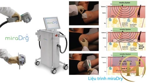 Liệu trình điều trị hôi nách vĩnh viễn bằng MyraDry 