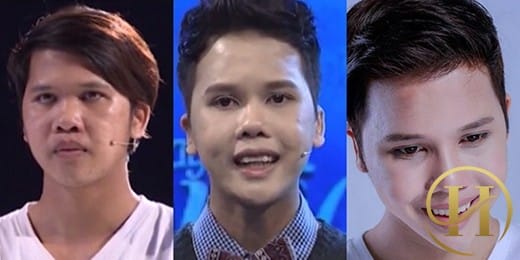 Chàng trai ở Tiền Giang "đổi đời" nhờ phẫu thuật thẩm mỹ