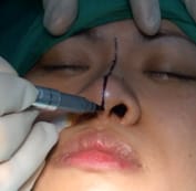  Bác sĩ sẽ tiến hành đo vẽ dựa vào các đặc điểm nhân trắc học của mũi và khuôn mặt. 