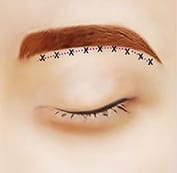  Tiến hành phẫu thuật nâng chân mày 