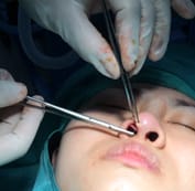  Phẫu thuật để chỉnh cấu trúc sụn đầu mũi để nâng cao, thu gọn đầu mũi, cánh mũi. 