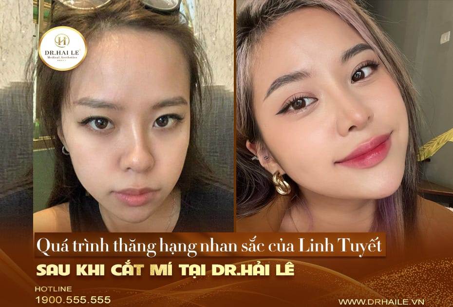 Quá trình thăng hạng nhan sắc của Tuyết Linh sau khi cắt mí tại Dr.Hải Lê