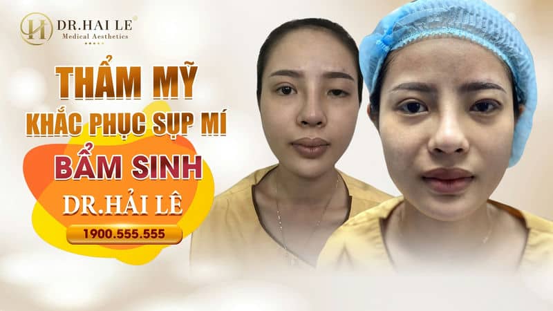 THẨM MỸ MẮT KHẮC PHỤC TÌNH TRẠNG SỤP MÍ BẨM SINH – CẢI THIỆN TẦM NHÌN, GIA TĂNG THẨM MỸ