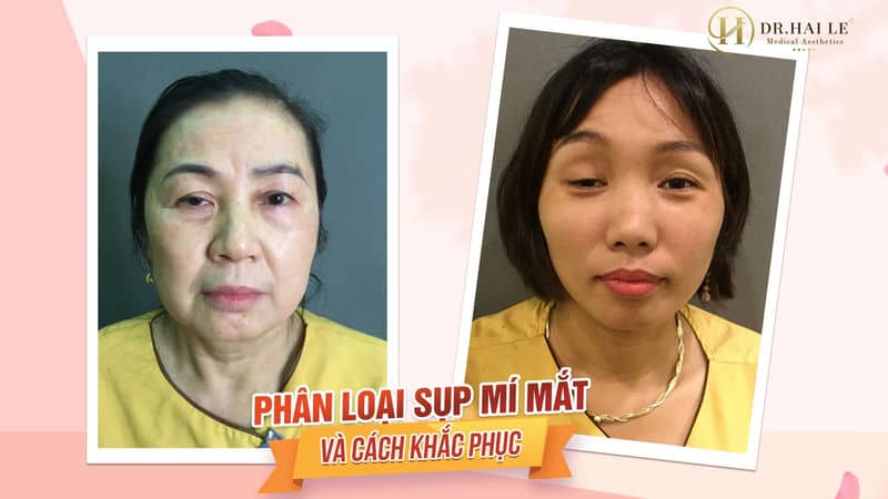 Phân loại sụp mí mắt và cách khắc phục !