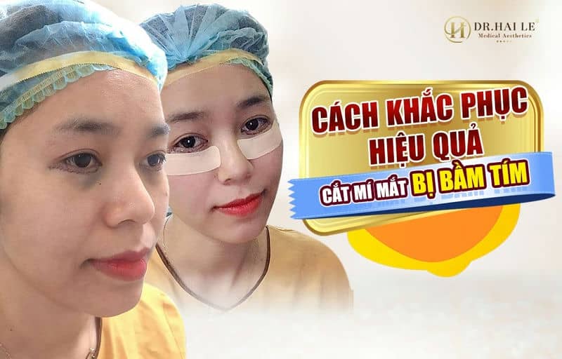 Hướng dẫn chăm sóc sau phẫu thuật thẩm mỹ mí mắt !