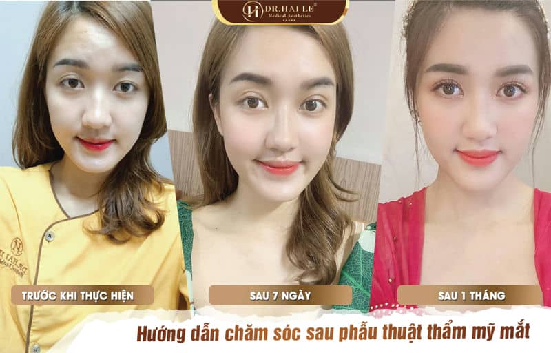 Hướng dẫn chăm sóc sau phẫu thuật thẩm mỹ mí mắt!