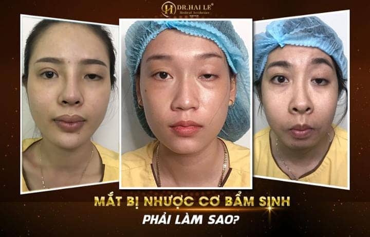 Sụp mí bẩm sinh có cải thiện hoàn toàn được không