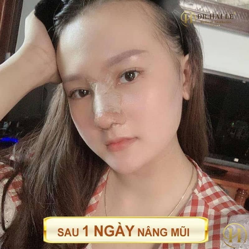 mũi sau 1 ngày
