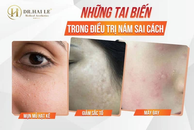 Những tai biến trong điều trị nám sai cách!