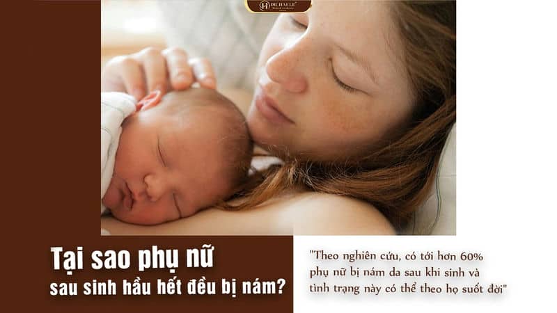 MÁCH MẸ CÁCH KHẮC PHỤC NÁM DA SAU SINH!