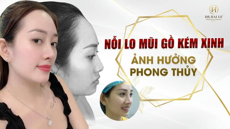 NỖI LO MŨI GỒ KÉM XINH, ẢNH HƯỞNG PHONG THỦY !