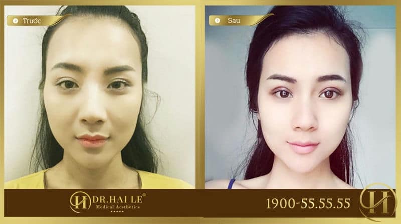 Kết quả sau cắt mí mắt không sưng tại Dr.Hải Lê