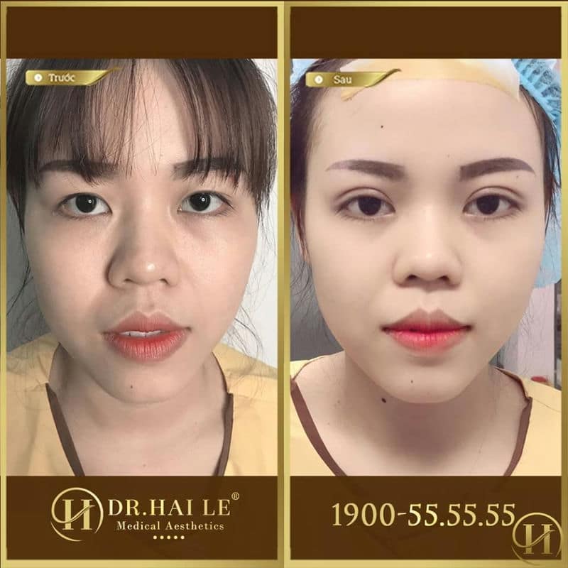 Kết quả trước sau khi cắt mí sụp tại Dr.Hải Lê