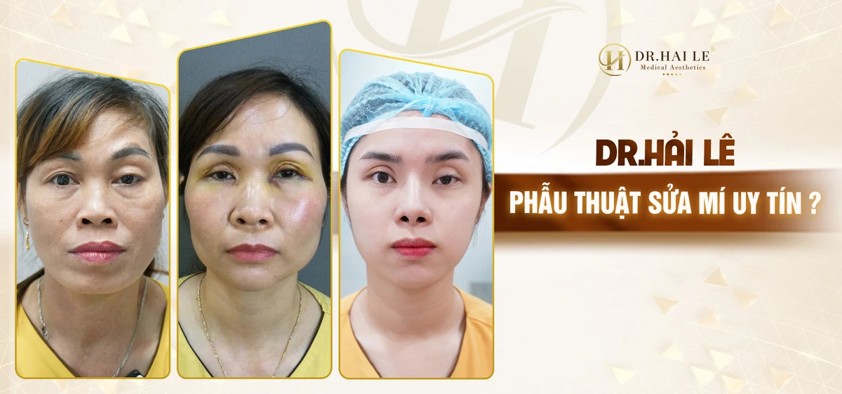 Dr.Hải Lê phẫu thuật sửa mí uy tín? Dr.Hải Lê phẫu thuật sửa mí uy tín?