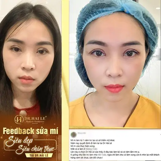 Chuyên gia sửa mí mắt Dr.Hải Lê