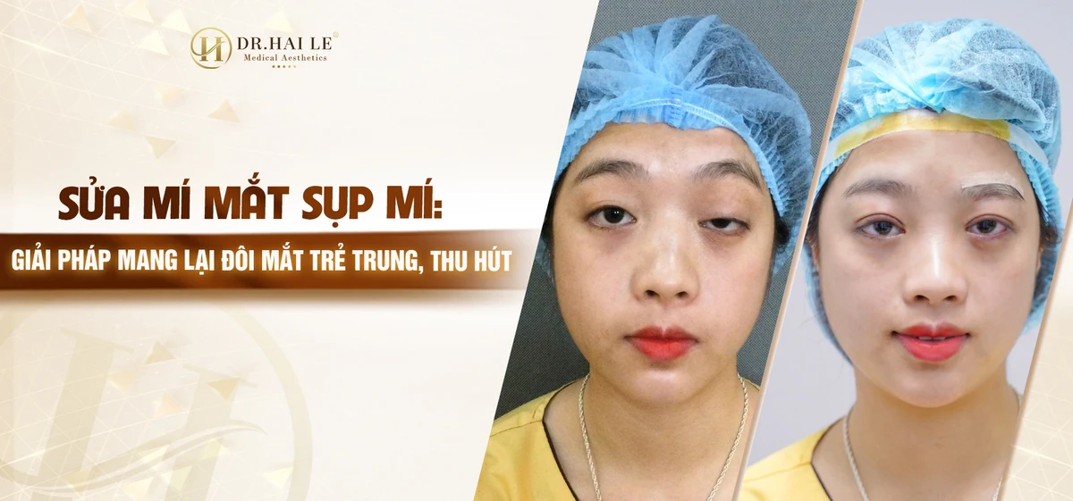 sua-mi-mat-sup-mi