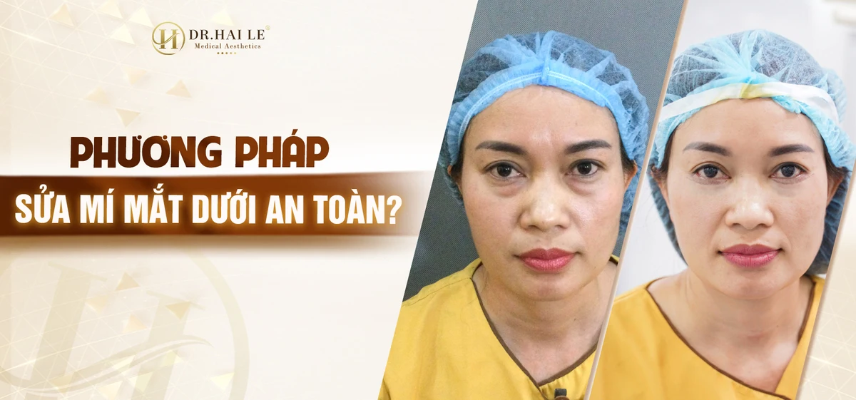 Sửa mí mắt dưới an toàn cần chú ý những gì?