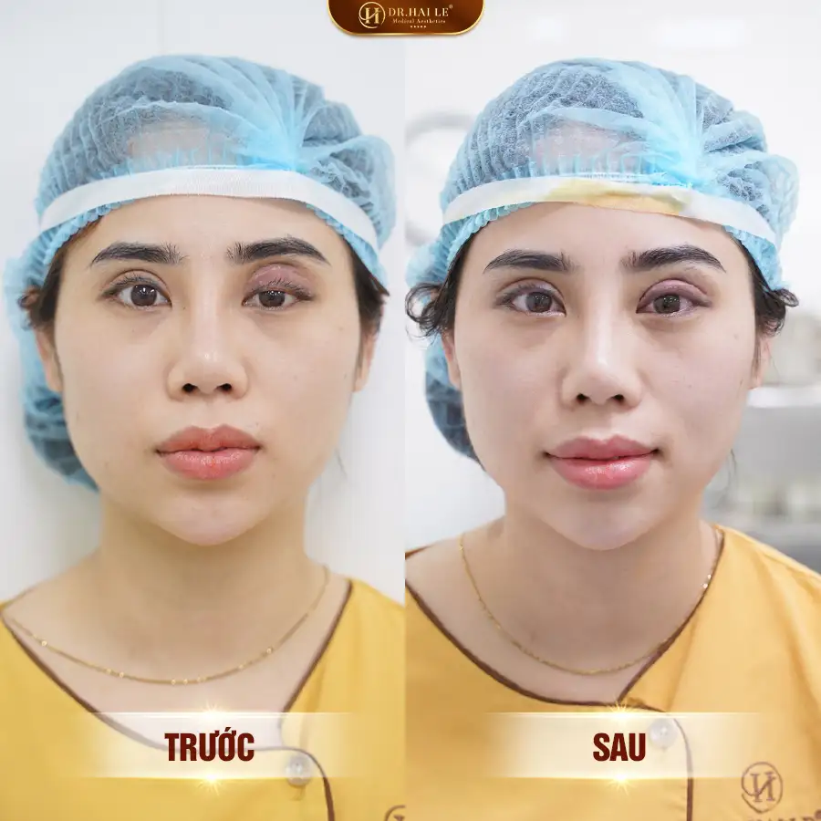 sua-mi-mat-lech-phai