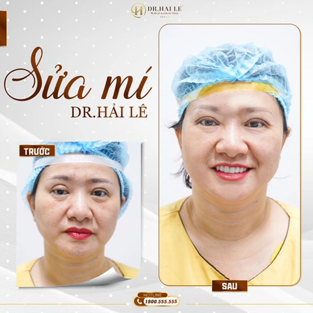 sua-mi-deep-tech-tai-drhai-le-tai-sinh-ve-dep-cho-cua-so-tam-hon