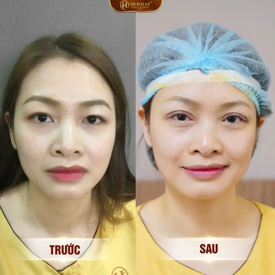 sua-mi-mat-khong-dau-rat