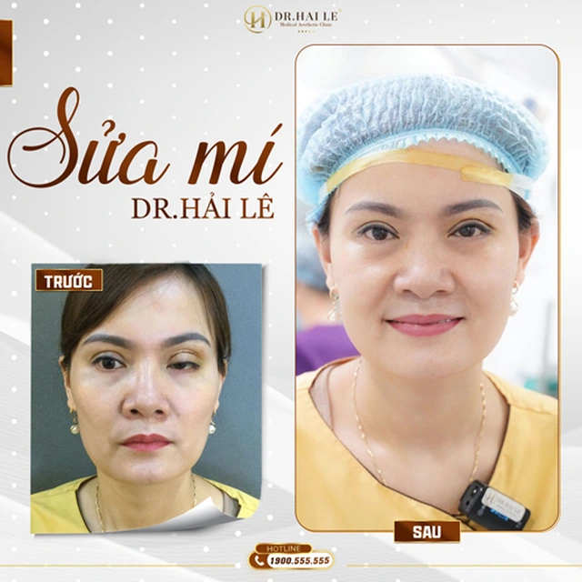 sua-mi-deep-tech-tai-drhai-le-tai-sinh-ve-dep-cho-cua-so-tam-hon