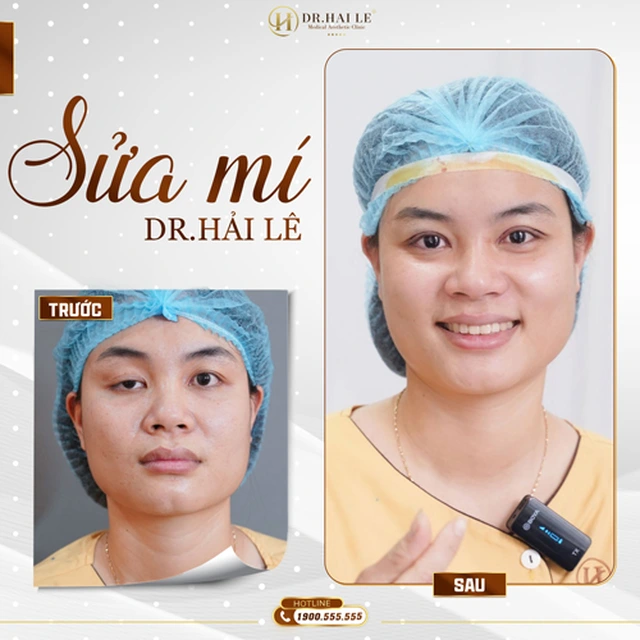 sua-mi-deep-tech-tai-drhai-le-tai-sinh-ve-dep-cho-cua-so-tam-hon
