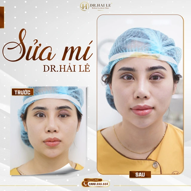 sua-mi-deep-tech-tai-drhai-le-tai-sinh-ve-dep-cho-cua-so-tam-hon