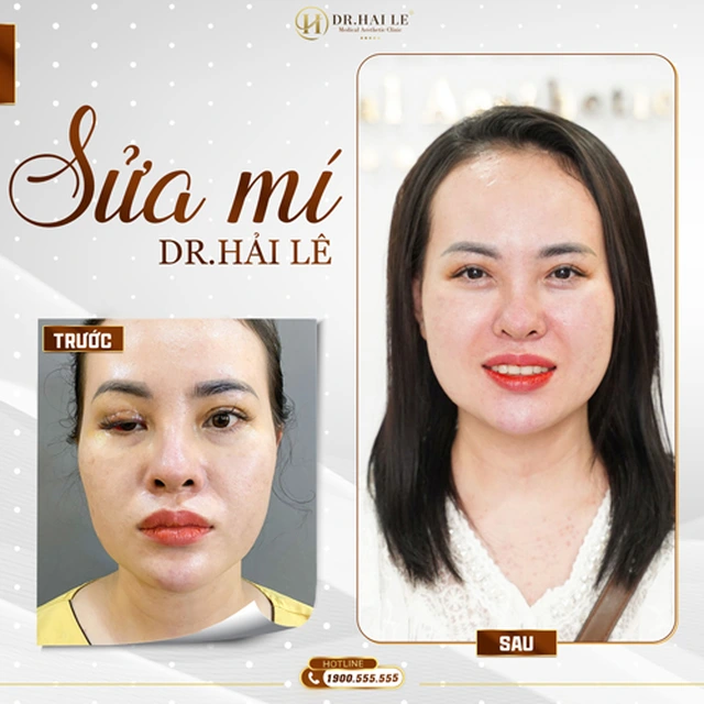sua-mi-deep-tech-tai-drhai-le-tai-sinh-ve-dep-cho-cua-so-tam-hon