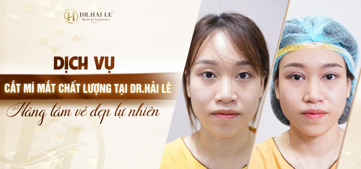 Dịch vụ cắt mí mắt chất lượng tại Dr.Hải Lê?