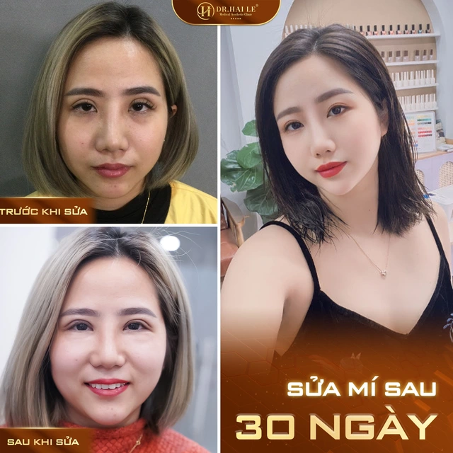 phau-thuat-sua-mi