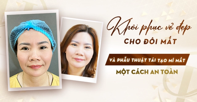 Khôi phục vẻ đẹp cho đôi mắt với phẫu thuật tái tạo mí mắt?