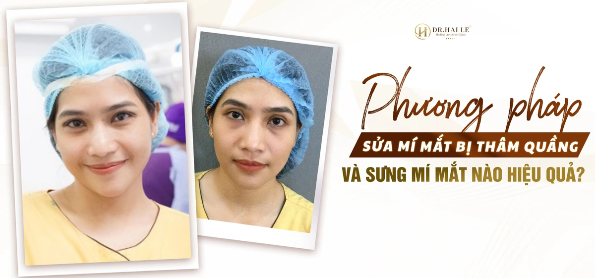 Phương pháp sửa mí mắt bị thâm quầng và sưng mí mắt nào hiệu quả?