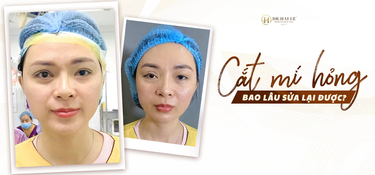 Cắt mí hỏng bao lâu sửa lại được?