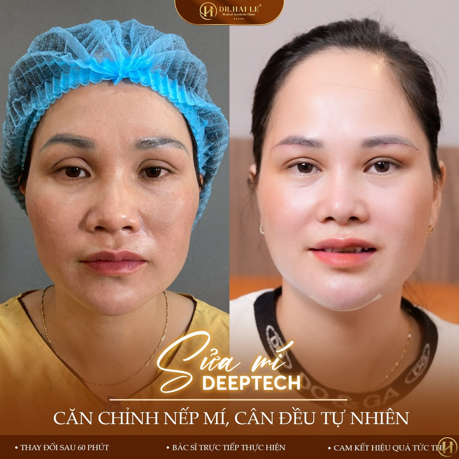 cach-khac-phuc-khi-cat-mat-bi-lat-mi