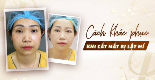 Cách khắc phục khi cắt mắt bị lật mí?