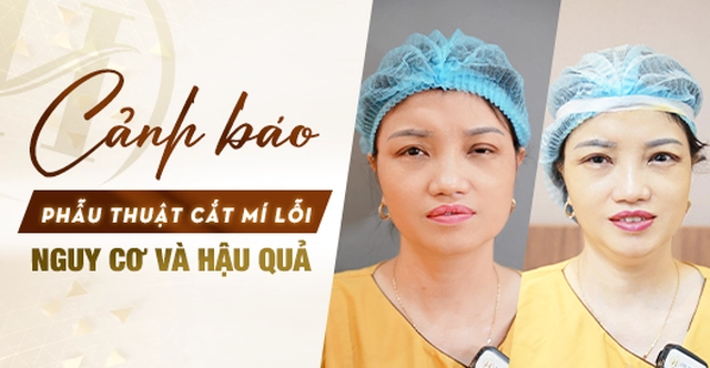 Cảnh báo phẫu thuật cắt mí mắt lỗi: Nguy cơ và hậu quả? Cảnh báo phẫu thuật cắt mí mắt lỗi: Nguy cơ và hậu quả?