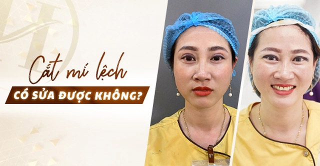 Cắt mí lệch có sửa được không?