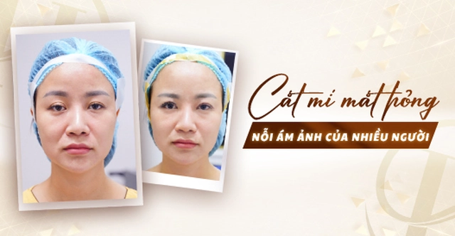 Cắt mí mắt hỏng - Nỗi ám ảnh của nhiều người?