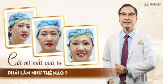 Cắt mí mắt quá to phải làm thế nào?