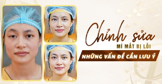 Chỉnh mí mắt bị lỗi: Những vấn đề cần lưu ý?