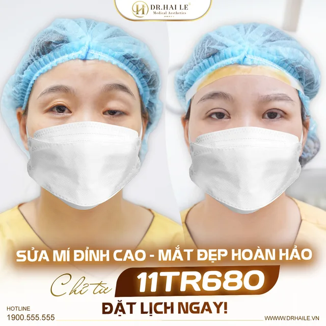 chia-se-kinh-nghiem-khac-phuc-mi-mat-khong-deu-thanh-cong