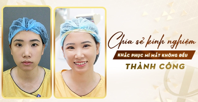 Chia sẻ kinh nghiệm khắc phục mí mắt không đều thành công?