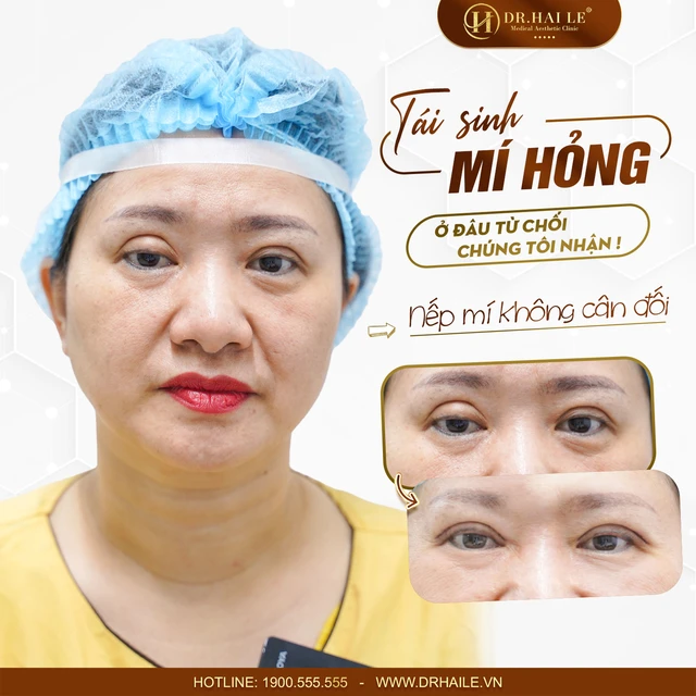 co-the-khac-phuc-mi-mat-cat-qua-to-khong