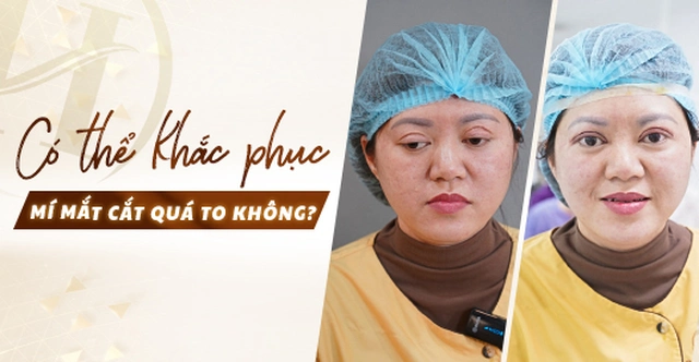 Có thể khắc phục mí mắt cắt quá to không?