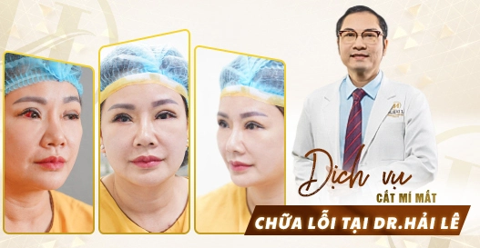 Dịch vụ cắt mí mắt chữa lỗi tại Dr.Hải Lê? Dịch vụ cắt mí mắt chữa lỗi tại Dr.Hải Lê?