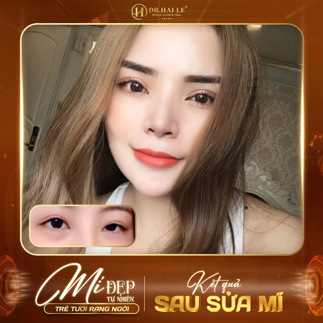 dich-vu-sua-mi-mat-chat-luong-tai-drhai-le-dep-tu-nhien-duy-tri-lau-dai