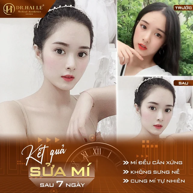 dich-vu-sua-mi-mat-chat-luong-tai-drhai-le-dep-tu-nhien-duy-tri-lau-dai