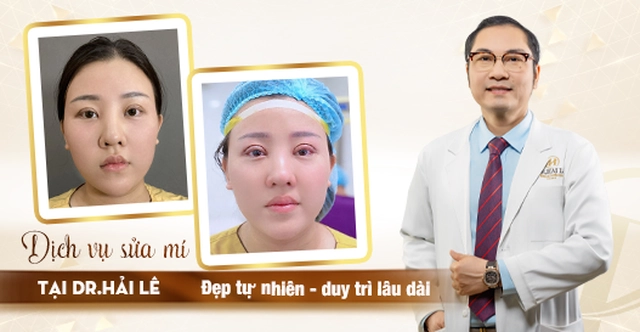 Dịch vụ sửa mí mắt chất lượng tại Dr.Hải Lê - Đẹp tự nhiên, duy trì lâu dài?
